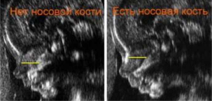 толщина воротникового пространства в 12 недель (главный ключ)